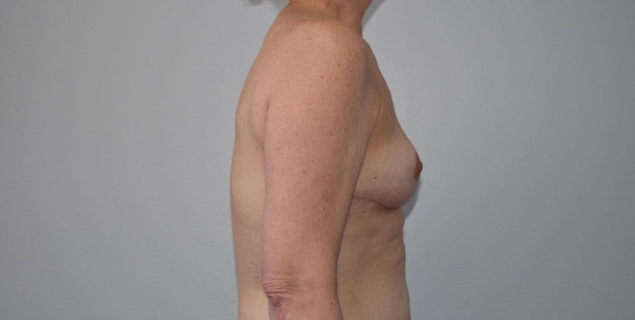 Explantlift8 After (Lateral)