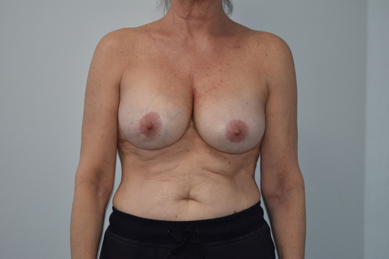 Explantlift8 Before (AP)