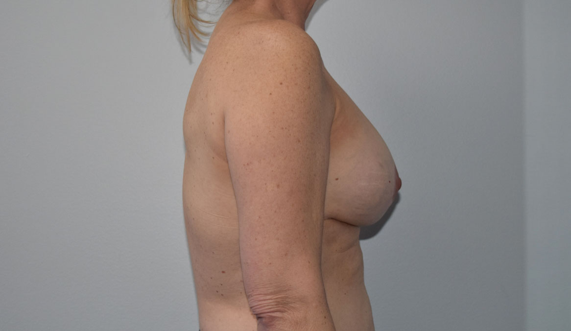 Explantlift8 Before (Lateral)