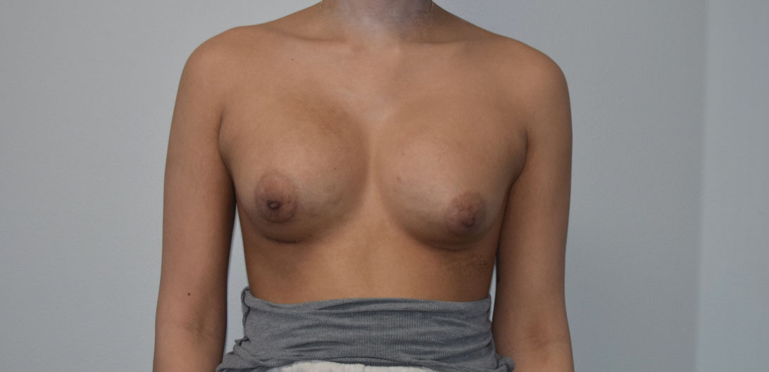 breast implant revision Before