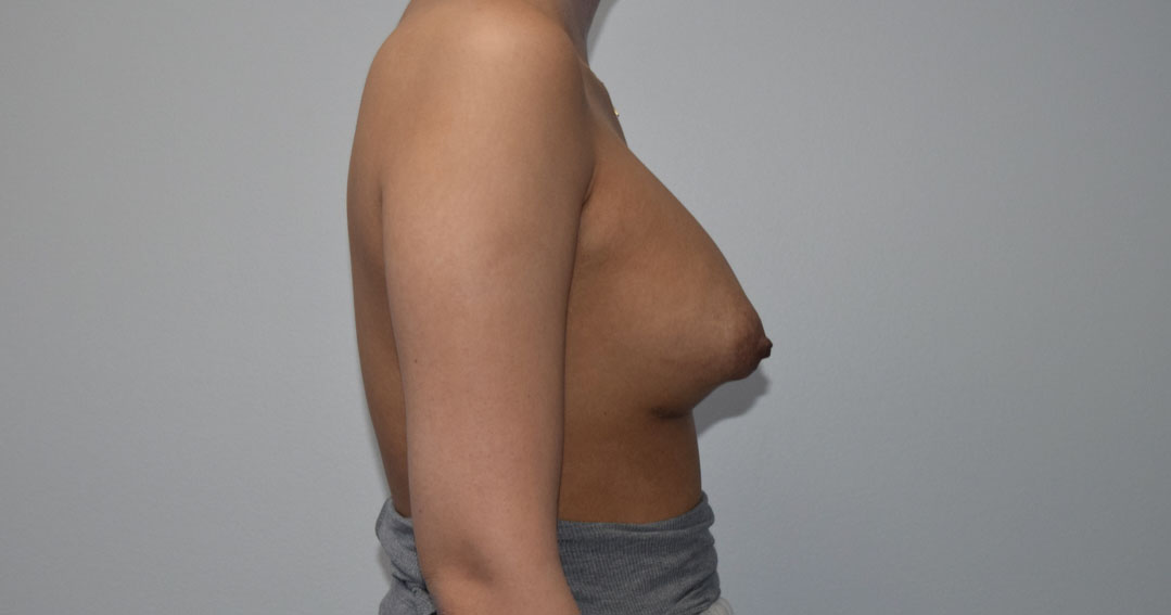 breast implant revision Before