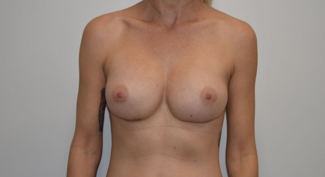 breast implant revision After