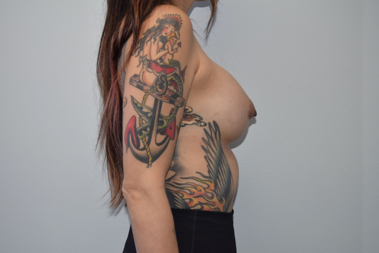 breast implant revision Before