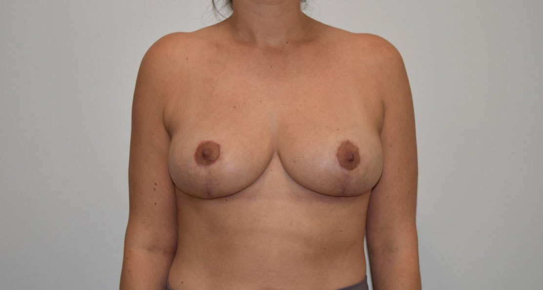Mastopexy1 After (AP)