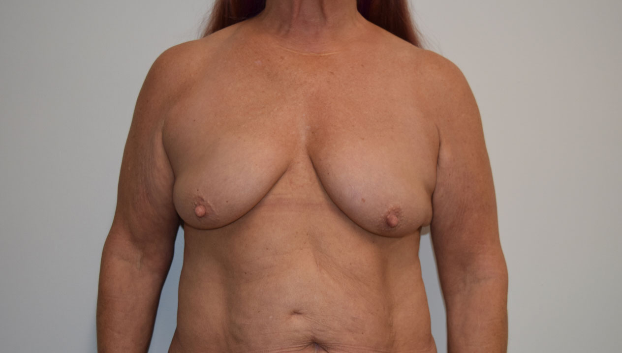Mastopexy3 Before (AP)