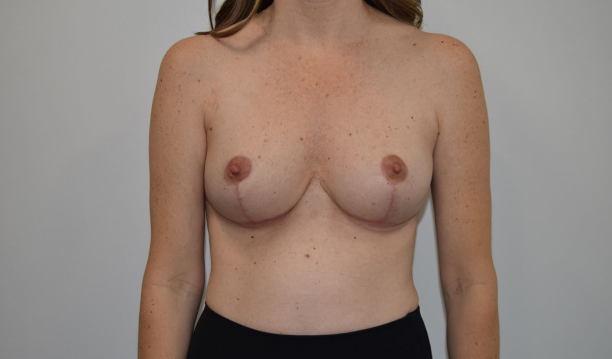 Reduction3 After (AP)