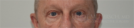 Blepharoplasty After