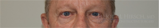 Blepharoplasty Before