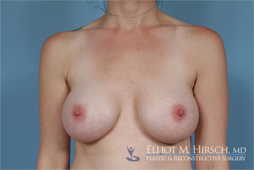 Breast Augmentation After