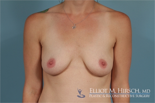 Breast Augmentation Before