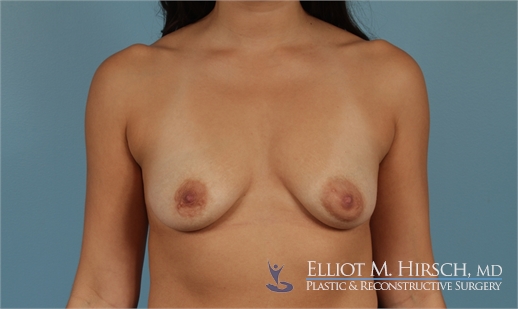 Breast Augmentation Before