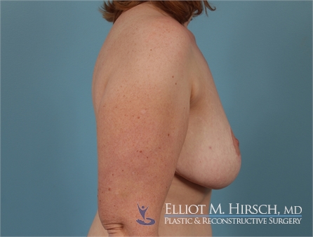 Breast Lift Before