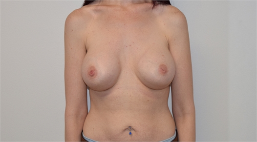 Breast Augmentation After