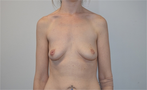 Breast Augmentation Before