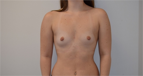 Breast Augmentation Before