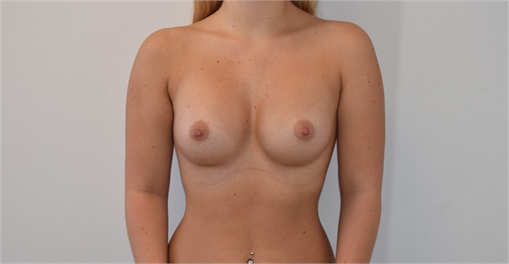 Breast Augmentation After