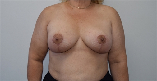 Breast Implant Revision After