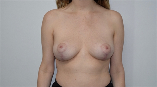 explant and mastopexy After