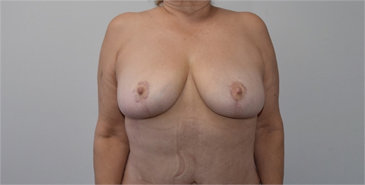 explant and mastopexy After