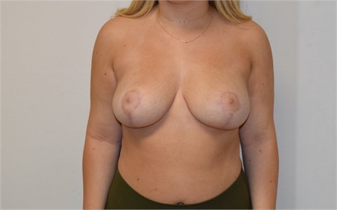 Breast Lift After