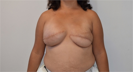 Breast Reconstruction Revision After