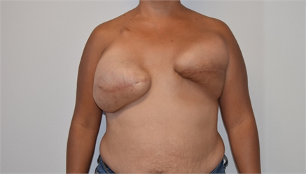 Breast Reconstruction Revision Before