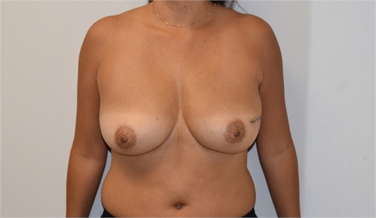 Two Stage Breast Reconstruction Before