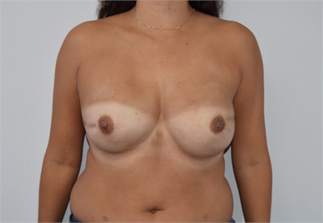 Two Stage Breast Reconstruction After