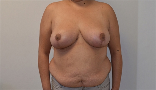 Breast Reduction After