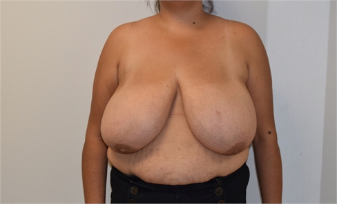 Breast Reduction Before