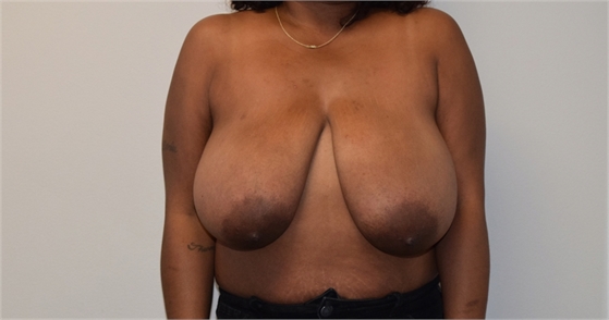 Breast Reduction Before