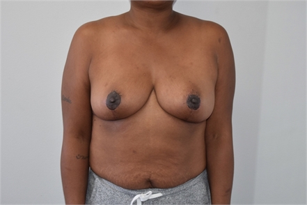 Breast Reduction After