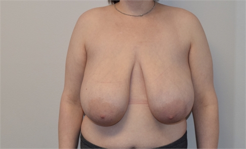 Breast Reduction Before