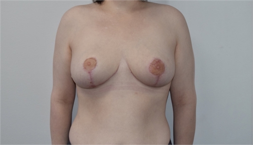 Breast Reduction After