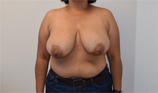 Breast Reduction Before