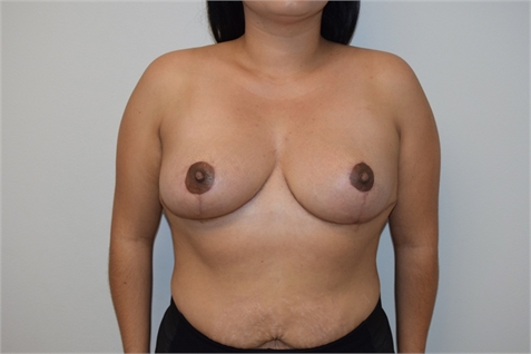 Breast Reduction After