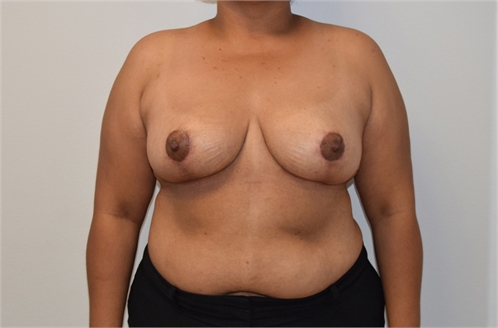 Breast Reduction After