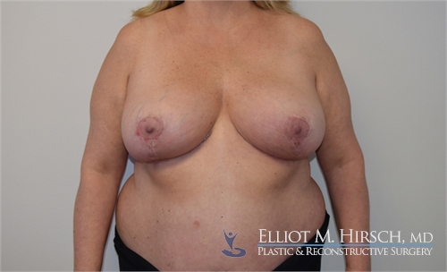 Breast Reduction After