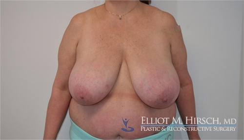 Breast Reduction Before