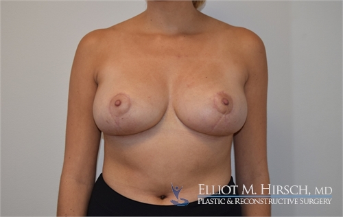 Breast Reduction After