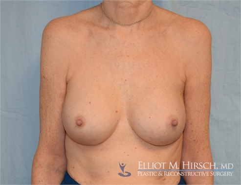 Breast Implant Revision After