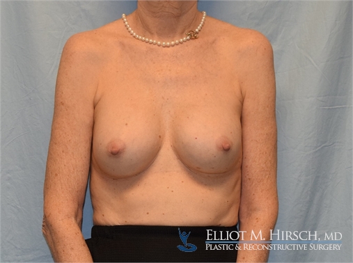 Breast Implant Revision Before