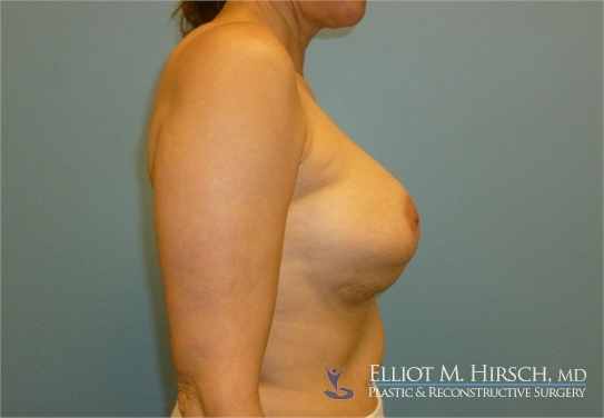 Breast Implant Revision Before