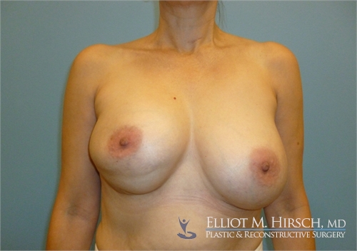Breast Implant Revision Before