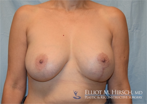 Breast Implant Revision After