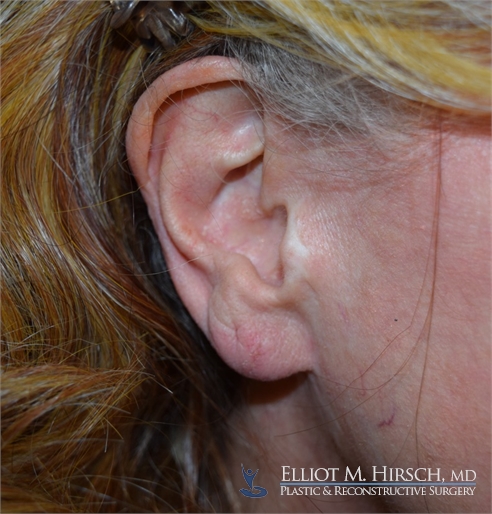 Split Earlobe Repair After