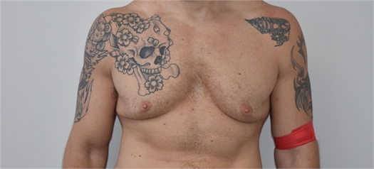 Male breast reduction Before