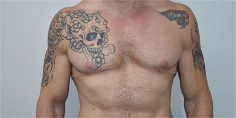 Male breast reduction After