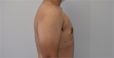 Male breast reduction After