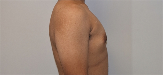 Male breast reduction Before